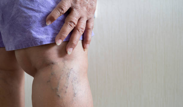 best dvt specialist doctor in navi mumbai