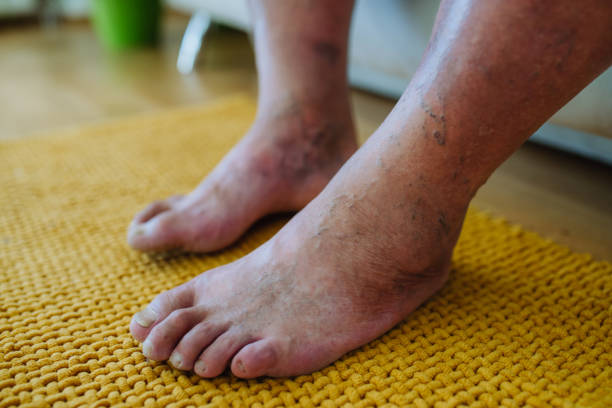 best non surgical & laser treatment for gangrene in navi mumbai