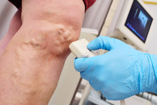 Vascular and Endovascular Surgeon For Varicose Veins in Navi Mumbai